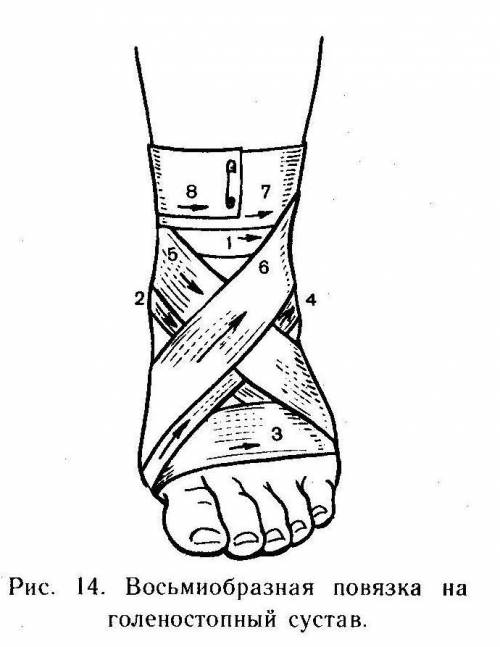 Какая повязка накладывается при голеностопный сустав при его повреждение. кратко
