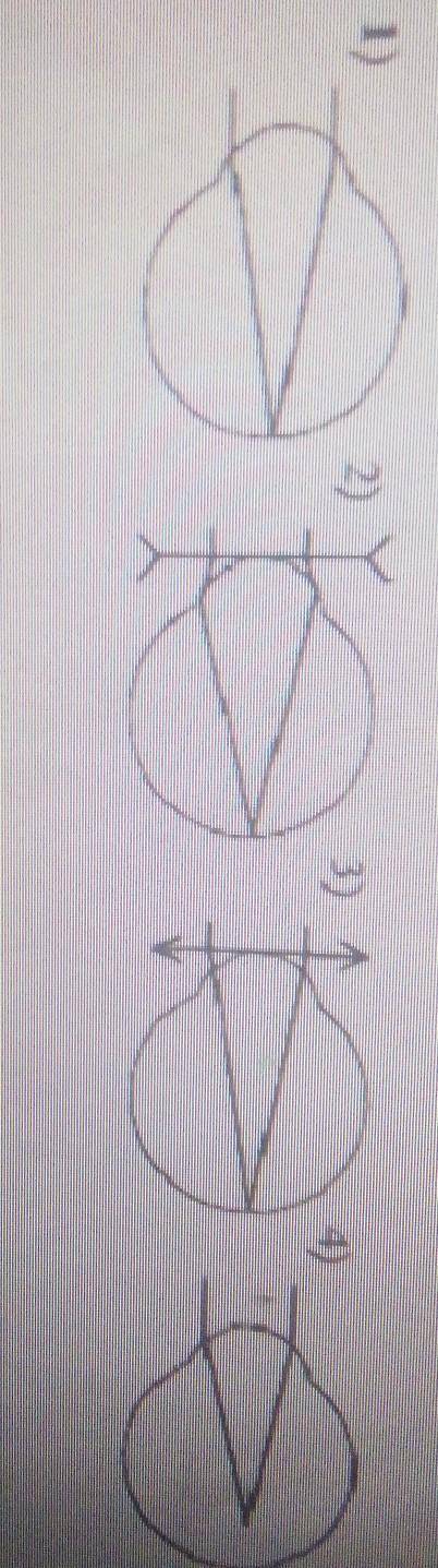 Какая из представленных на рисунке схем хода параллельного пучка лучей соответствует случаю нормальн