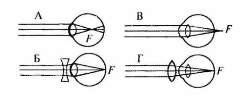 Какая из схем хода лучей в глазу человека соответствует случаю дальнозоркости глаза без очков?​
