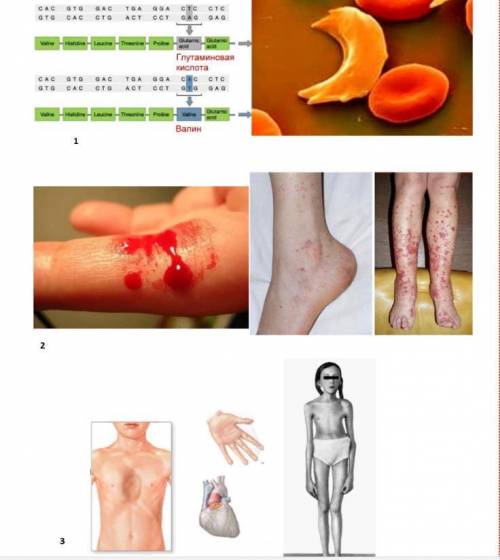 Какие заболевания изображены на данных рисунках? К какому виду мутаций они относятся? Назовите причи