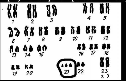 На рисунке изображен хромосомный набор человека. (а) Определите, какое наследственное заболевание по